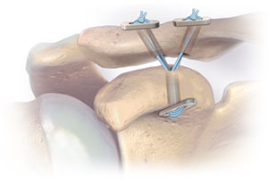 akute-gelenksverletzung