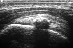 Kalkdepot im Ultraschall