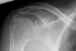Röntgenbild Kalkschulter