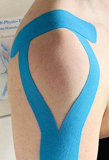 Blaues Kinesiotape auf Schulter