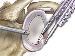 Einbringen eines Fadens