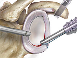 Verknoten des abgerissenen Labrumanteils