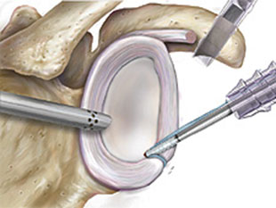 Einbringen des Ankers am knöchernen Glenoidrand