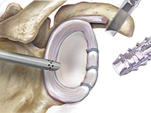 Stabile Fixierung der Gelenklippe