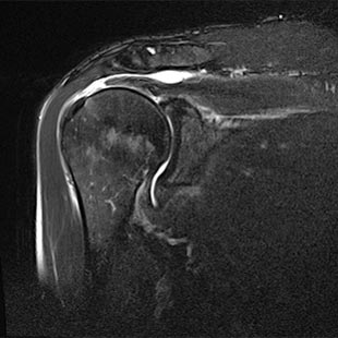 MRT-Bild Rotatorenmanschette: Abriss der Sehne