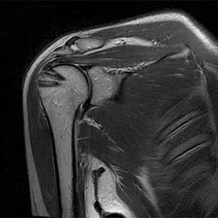 MRT-Bild Rotatorenmanschette: Nach Rekonstruktion