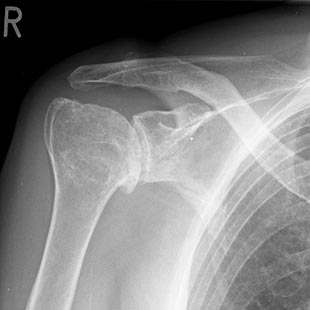 Schultergelenksarthrose