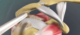 Sehnenabriss: Einbringung eines Abstandhalters, 1