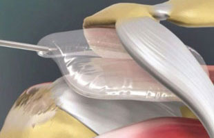 Sehnenabriss: Einbringung eines Abstandhalters, 3