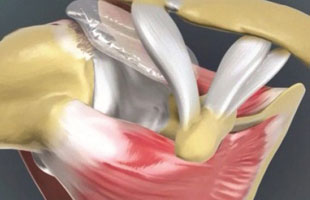 Sehnenabriss: Einbringung eines Abstandhalters, 4